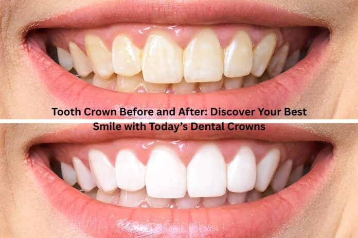 Tooth Crown Before and After: Discover Your Best Smile with Today’s Dental Crowns
