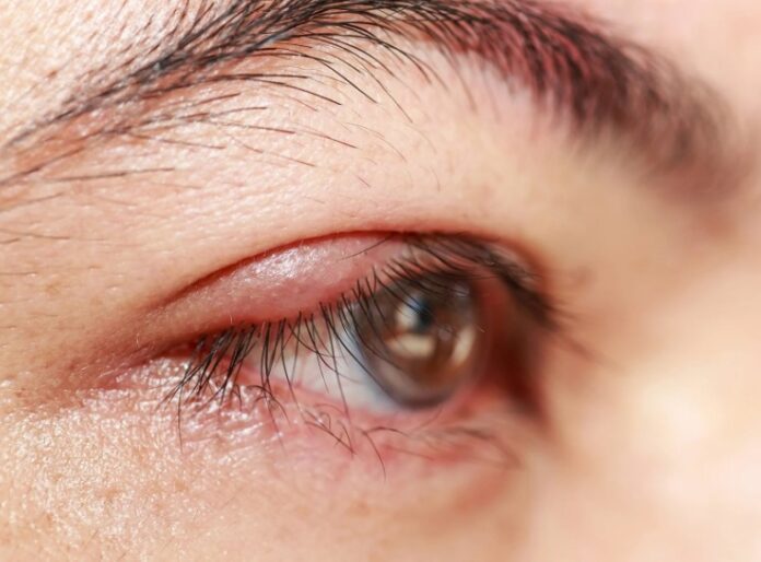 Why Do I Keep Getting Styes? Causes & Prevention Guide