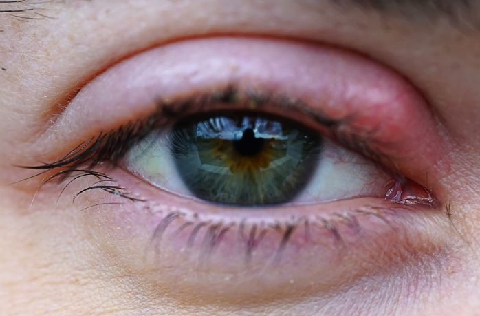 Why Do I Keep Getting Styes? Causes, Prevention, and Treatment